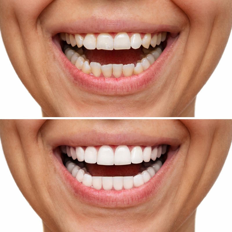 Before & after results of dental smile makeover in Kalamazoo, MI