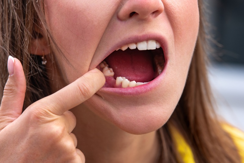 A young woman in need of a dental bridge procedure for her tooth in Kalamazoo, MI