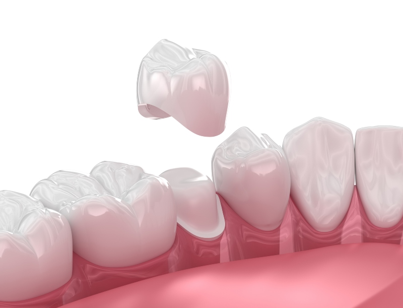 3D illustration of dental crown placement over the tooth in Kalamazoo, MI