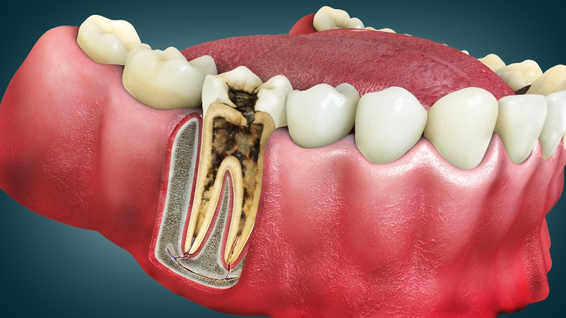 3D illustration of damaged tooth in need of root canal treatment in Kalamazoo, MI