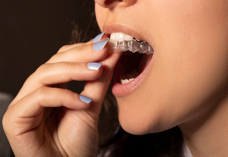 Do’s and Don’ts of Clear Aligners in Kalamazoo, MI